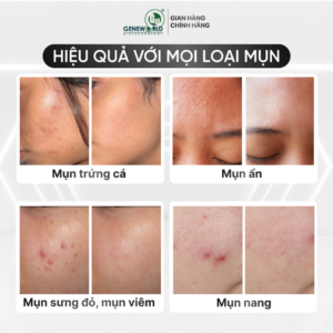 BSB SOLUTION – Dung dịch kháng khuẩn phục hồi da mụn